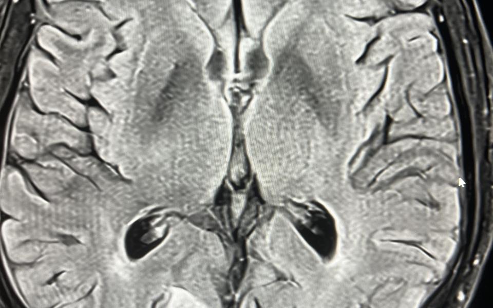 Ophthalmology Case Reports International Ophthalmology Portal Ophthalmology Case Reports International Ophthalmology Portal